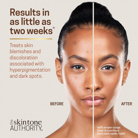 Ambi Skincare Fade Cream for Normal Skin | Dark Spot Remover for Face and Body | Treats Skin Blemishes & Discoloration | Improves Hyperpigmentation | Corrector | 2 Ounce