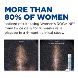 Women's Rogaine 5% Minoxidil Foam for Hair Thinning and Loss, Topical Treatment for Women's Hair